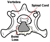 End-on illustration depicting changes seen with diskospondylitis